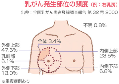 乳がんの発生部位の頻度